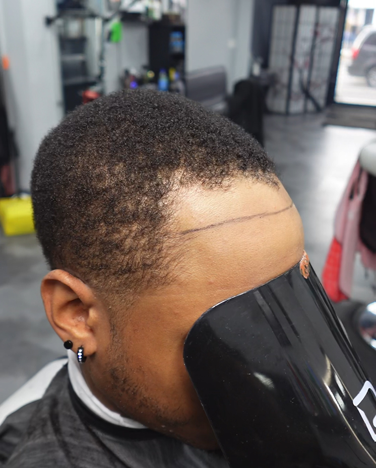 Hairline Repair - before
