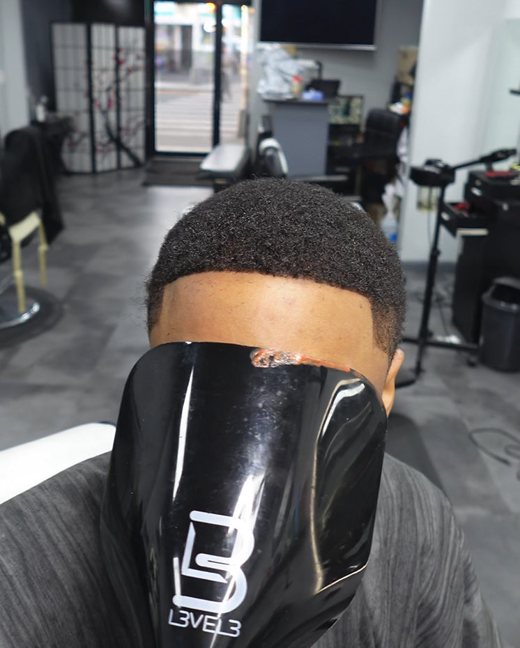 Hairline Repair - after