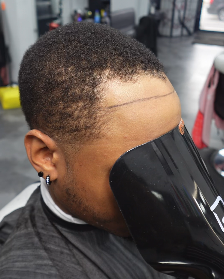 hairline-repair-before
